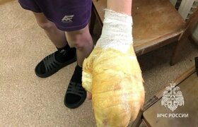 В Ижевске дети пострадали при взрывании петард